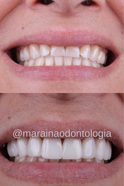 lentes e facetas em resina