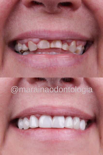 lentes e facetas em resina